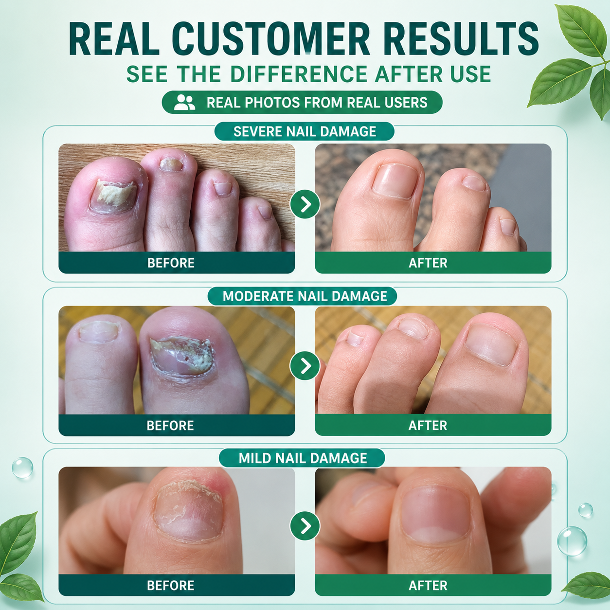 Plant-Based Nail Renewal Patch | Healthy-Looking Nails | Onychomycosis Treatment